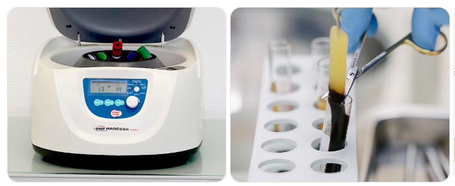 PRF-Zentrifuge und Aufbereitung des Eigenbluts